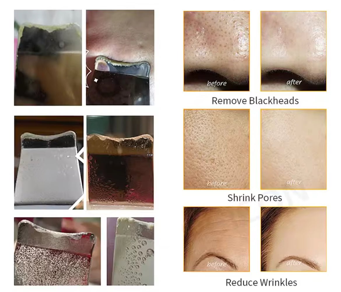 Ultraschallpeelinggerät – Tiefenreinigendes porenreiniger Skin Scrubber fürs Gesicht - Glanzhaut